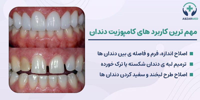 مهم ترین کاربرد های کامپوزیت دندان