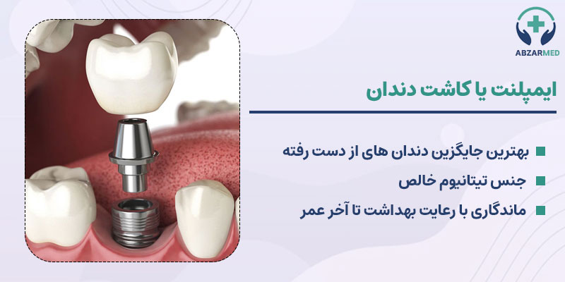 ایمپلنت یا کاشت دندان: پروتز ثابت دندان