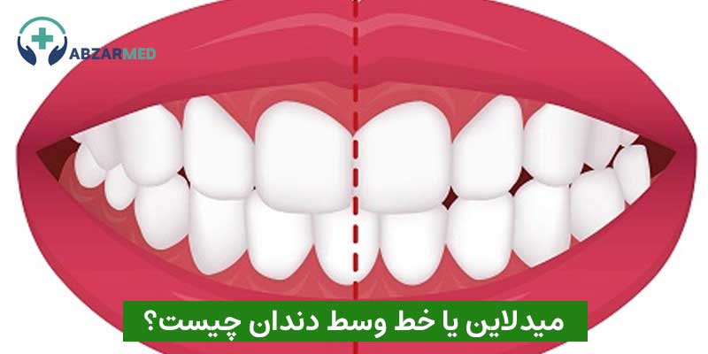 میدلاین | بهترین درمان برای انحراف یا ناهماهنگی خط وسط دندان
